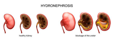 Vector illustration of blockage of the ureter. hydronephrosis.のイラスト素材