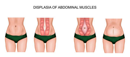 illustration of abdominal muscle diastasisのイラスト素材