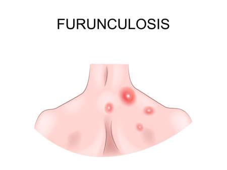 vector illustration of chronic boils on the back of a manのイラスト素材