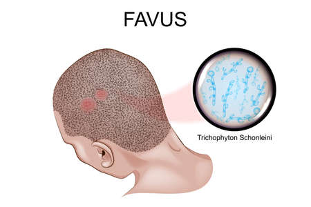 Vector illustration of the favus, fungal infection of the skinのイラスト素材
