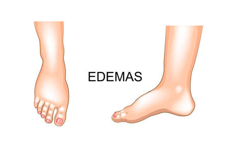 vector illustration of edema on feet. swellingのイラスト素材