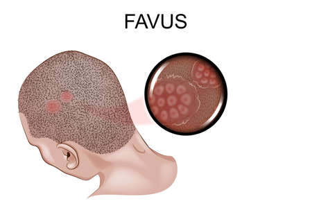 Vector illustration of the favus, fungal infection of the skinのイラスト素材