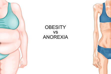 vector illustration of female figure with anorexia and obesityのイラスト素材