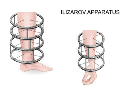 vector illustration of the Ilizarov apparatus for treatment of bone fracturesのイラスト素材