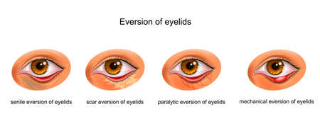 vector illustration of the cause of the eyelidのイラスト素材