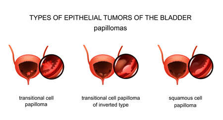 vector illustration of bladder epithelial tumors. urologyのイラスト素材