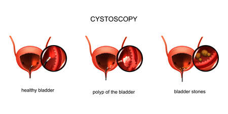 cystoscopy of the bladder. stones and polyp.のイラスト素材