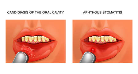 candidiasis and aphthous stomatitisのイラスト素材