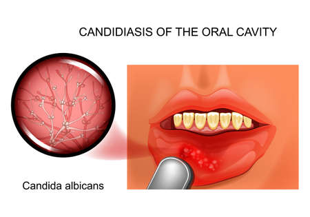 candidiasis of the oral cavityのイラスト素材