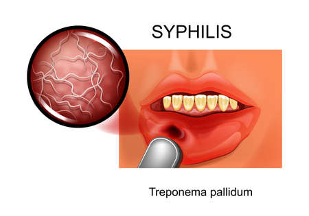 syphilis. chancre. Treponema pallidumのイラスト素材