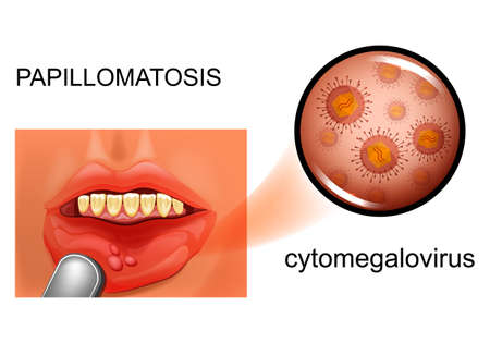 papillomatosis of the oral mucosaのイラスト素材