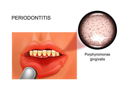 vector illustration of periodontitis. bleeding gums. stomatologyのイラスト素材