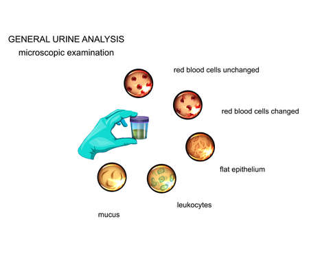 vector illustration of the General analysis of urine. microscopyのイラスト素材
