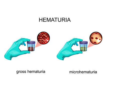 vector illustration of hematuria. blood in urineのイラスト素材