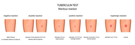 vector illustration of the assessment of reaction to a Mantoux testのイラスト素材