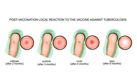 vector illustration of post-vaccination reactions to the vaccine against tuberculosisのイラスト素材