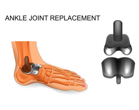 foot skeleton. ankle replacementのイラスト素材