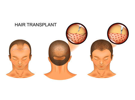 vector illustration of hair transplantation of the occipital part of the head on the frontalのイラスト素材