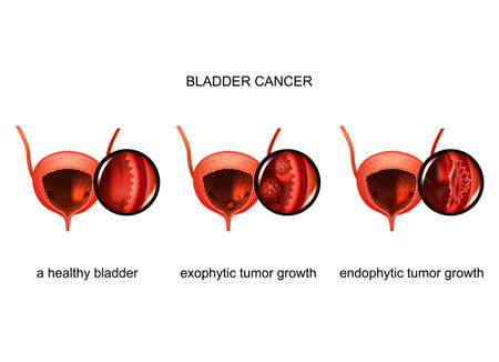 vector illustration of exophytic and endophytic growth of cancer in the bladderのイラスト素材