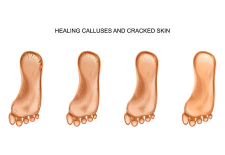 healing calluses and cracked heelsのイラスト素材