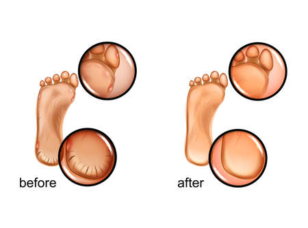 calluses and cracks of heelsのイラスト素材