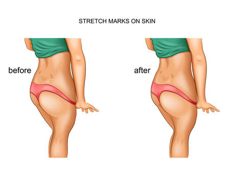 stretch marks. before and afterのイラスト素材