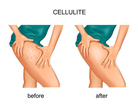 vector illustration of cellulite on a woman's thighのイラスト素材