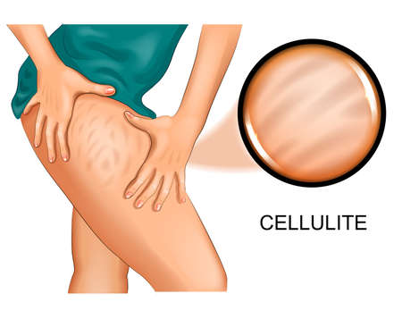 cellulite on a womans thighのイラスト素材
