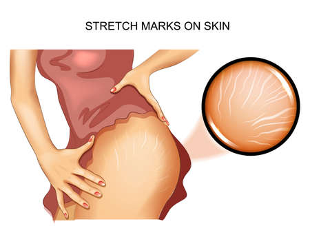illustrastretch marks on the skin.のイラスト素材