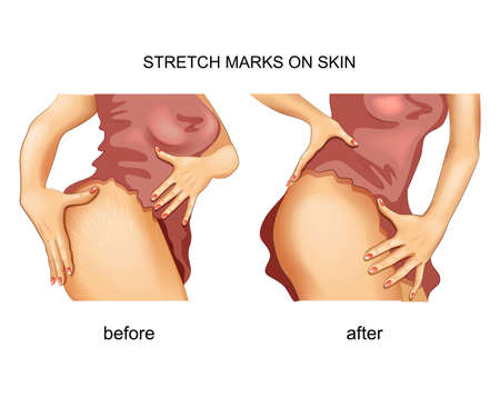 stretch marks on the skin.のイラスト素材