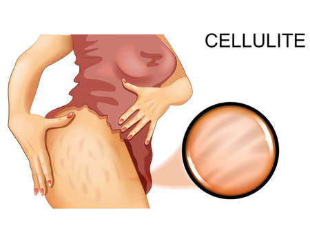 cellulite on a womans thighのイラスト素材