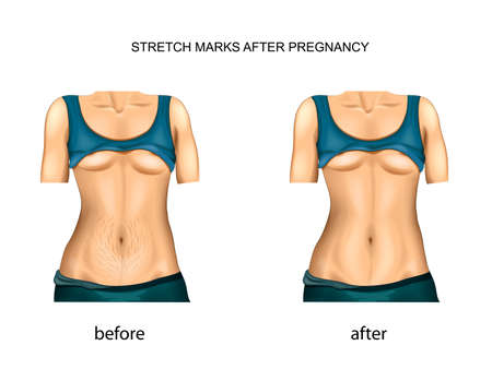 stretch marks after pregnancy. before and after.のイラスト素材