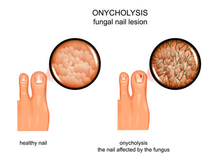 vector illustration of fungal nail lesion. infection, onycholysisのイラスト素材
