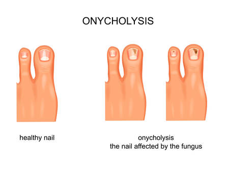 fungal nail infection, onycholysisのイラスト素材
