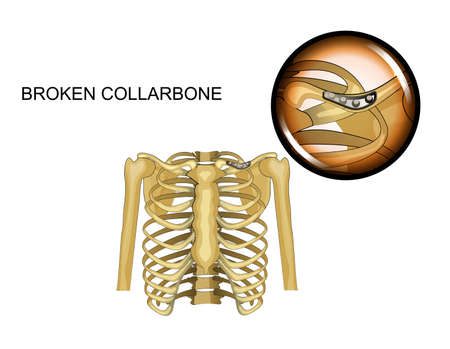 vector illustration of a broken collarbone. osteosynthesisのイラスト素材