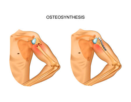 vector illustration of osteosynthesis in the fracture of the humerus headのイラスト素材