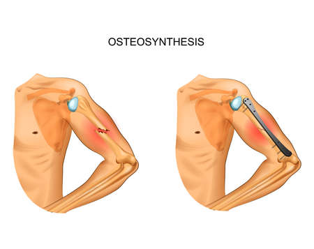 osteosynthesis of the body of the humerusのイラスト素材