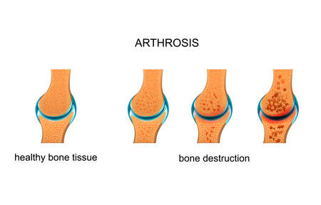 vector illustration of arthrosis. destruction of bone tissueのイラスト素材