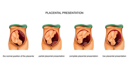 vector illustration of placental presentation norm and pathologyのイラスト素材