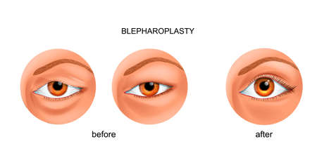 blepharoplasty of the overhanging eyelid and Asian eyelidのイラスト素材