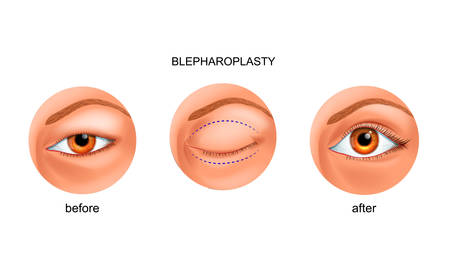 blepharoplasty of the Asian eyelidのイラスト素材