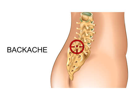 vector illustration of pain in the sacrum and lumbar vertebraeのイラスト素材