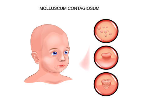 Molluscum contagiosum in a child.のイラスト素材