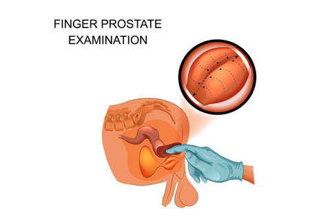 finger prostate examinationのイラスト素材