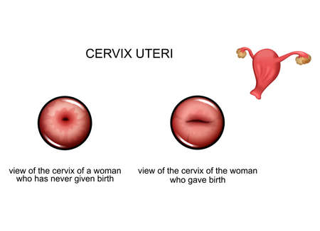 cervix before and after childbirthのイラスト素材