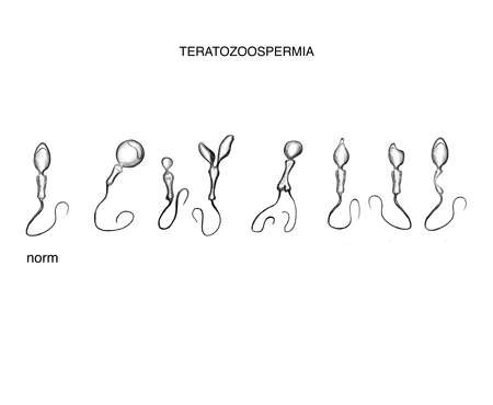 Illustration of the defect sperm. Teratozoospermiaの写真素材