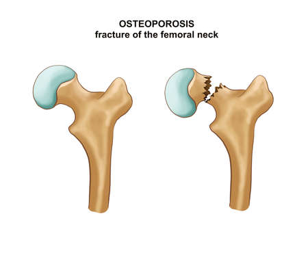 Illustration Of Osteosynthesis. Hip fractureの写真素材