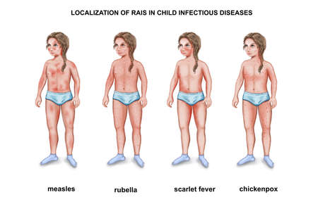 Illustration of the localization of rains in child? infectious diseasesの写真素材