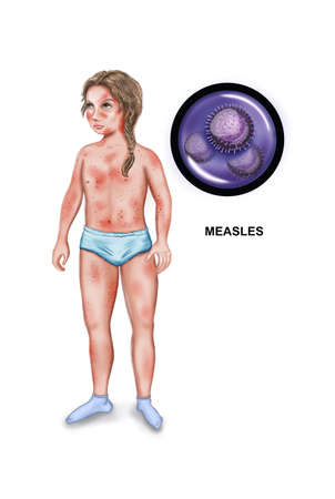 Illustration of the measles virus, child? infectious diseasesの写真素材