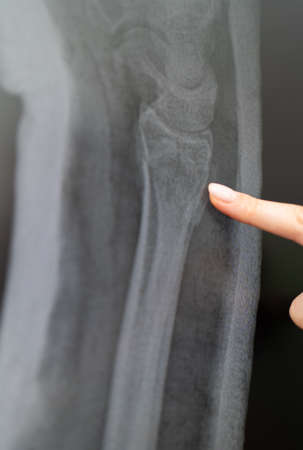X-ray of the arm bone. Radiologist examines the crack.
